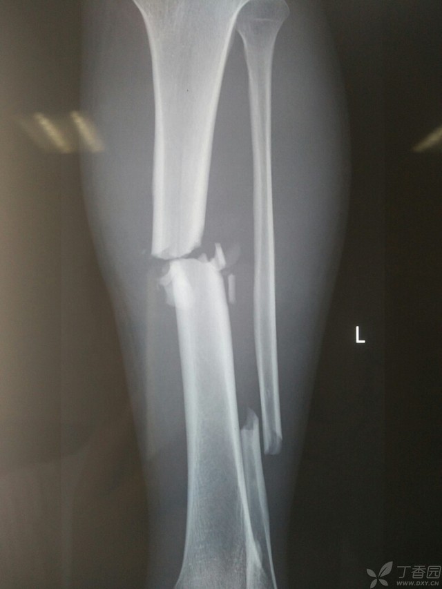 科技重塑脛腓骨骨折康復之旅，引領未來體驗新篇章