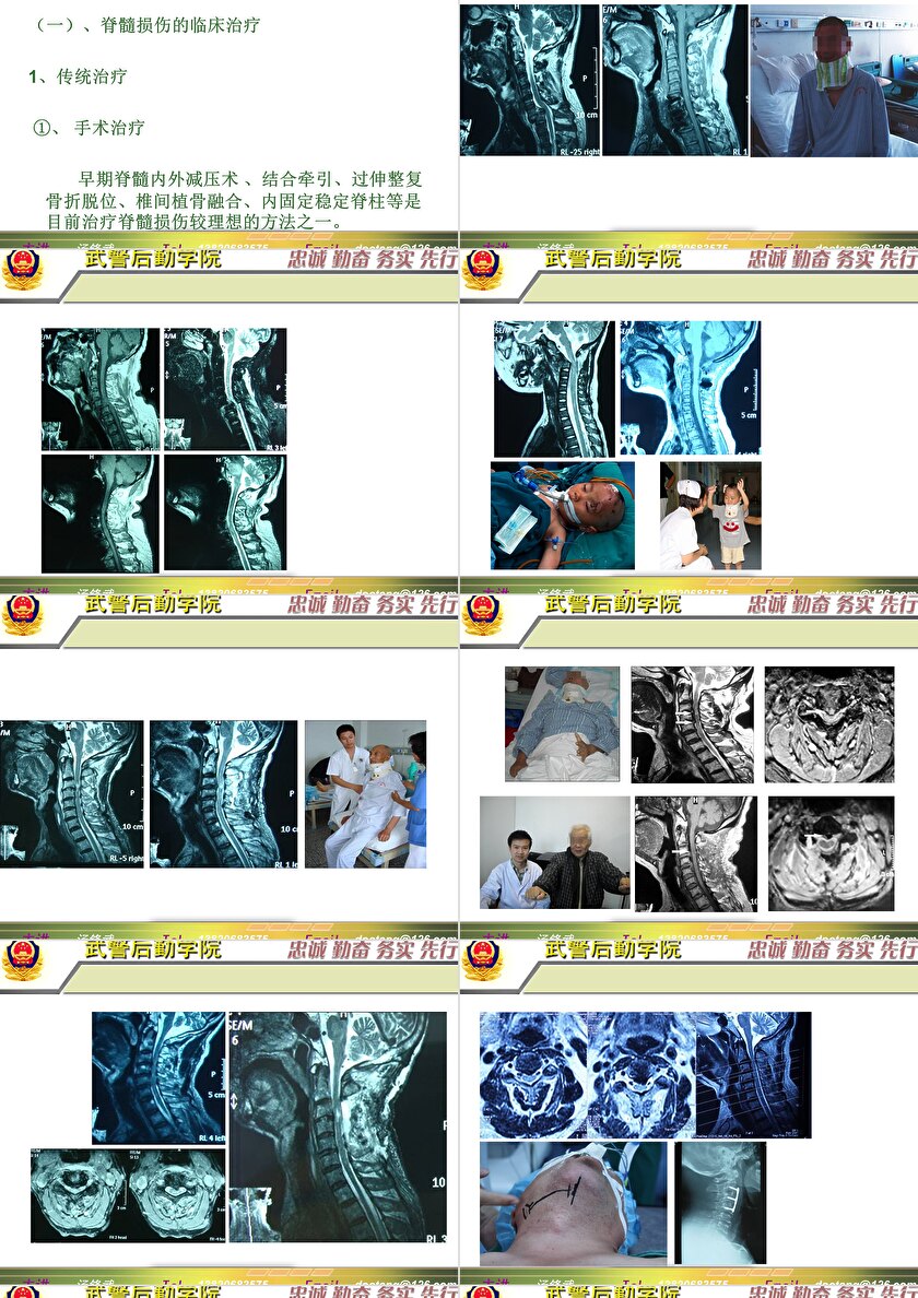 2023年脊髓損傷研究新進展，里程碑式的突破與日常奇妙變化