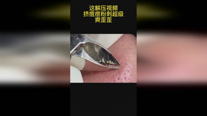 最新擠膿包視頻，見(jiàn)證變化的力量，自信與成就感的誕生之地