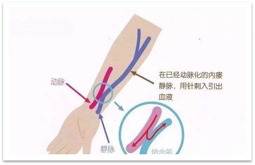 靜脈瘺最新資訊，掌握最前沿的健康信息